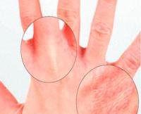 Аллергия на пальцах рук: причины, симптомы, лечение